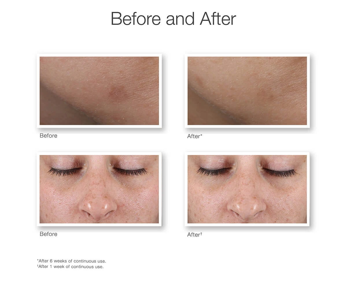murad dark spot