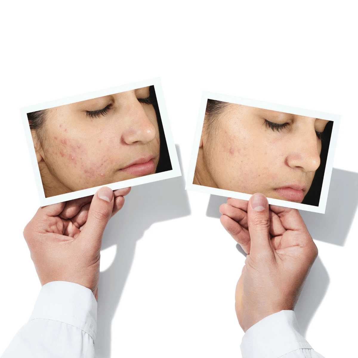 murad blemish control invisiscar